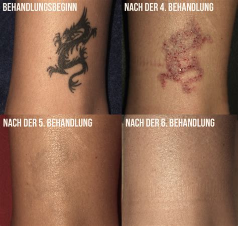 Übelkeit nach sport am nächsten tag