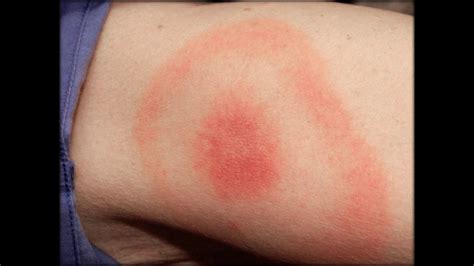 Was Sind Die Symptome Bei Borreliose