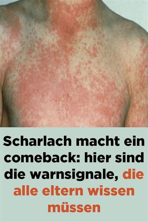 Was Sind Die Symptome Für Scharlach