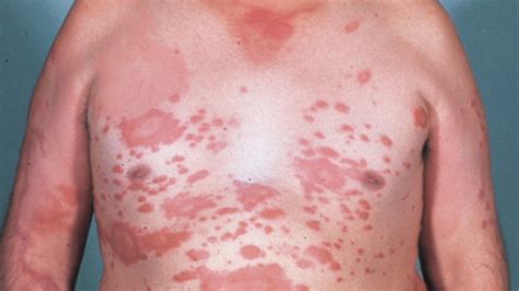 Was Sind Die Symptome Von Lepra