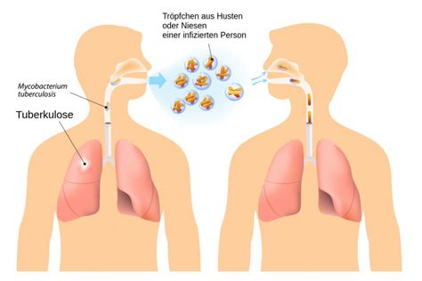 Was Sind Die Symptome Von Tuberkulose